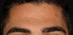 Botox - Case #1 After